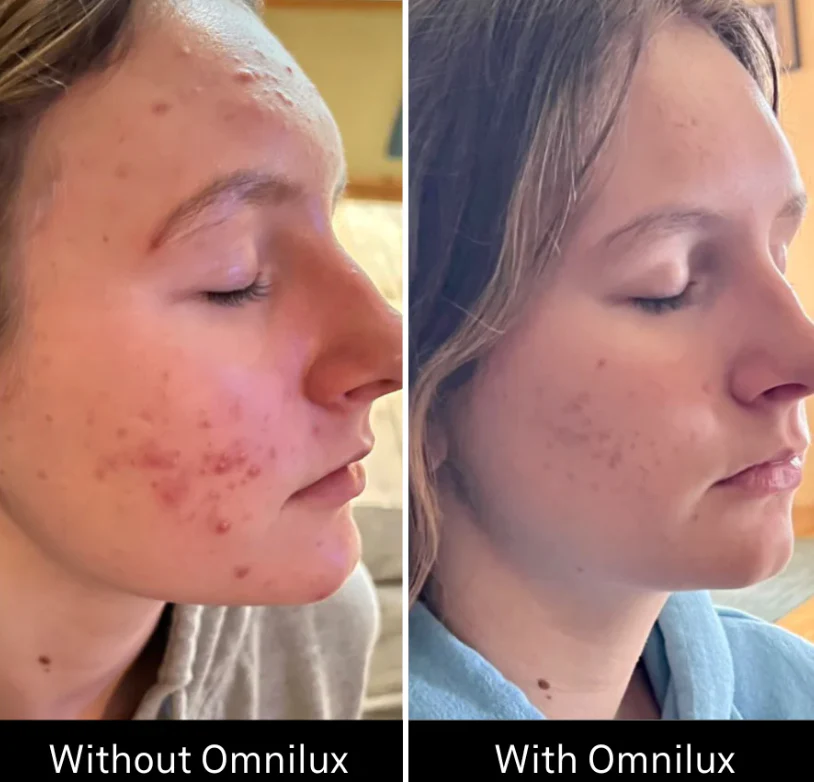 Omnilux Clear - Image 10