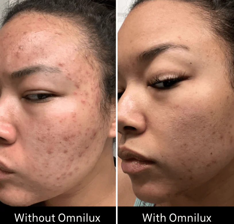 Omnilux Clear - Image 7
