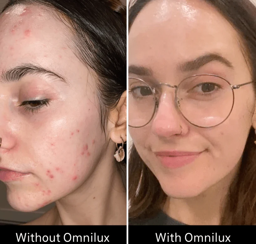 Omnilux Clear - Image 8