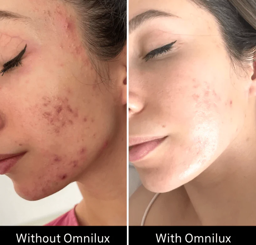 Omnilux Clear - Image 9