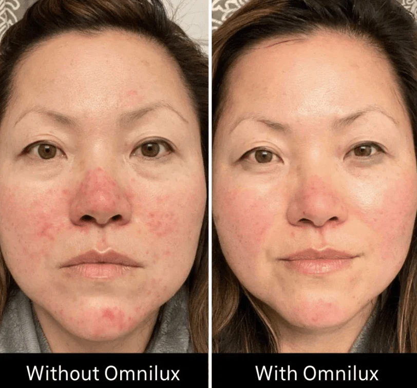 Omnilux Contour Face - Image 8