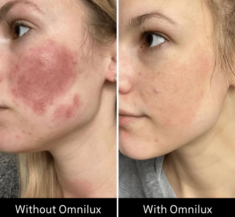 Omnilux Contour Face - Image 9