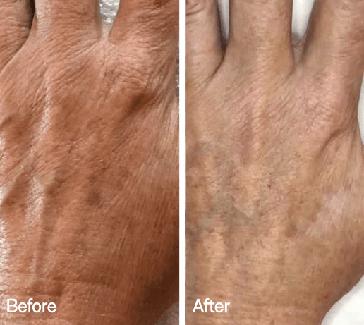 Omnilux Contour Glove - Image 10