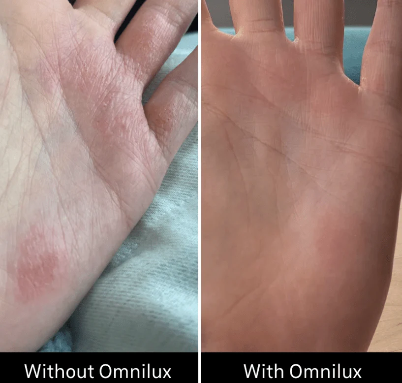 Omnilux Contour Glove - Image 11