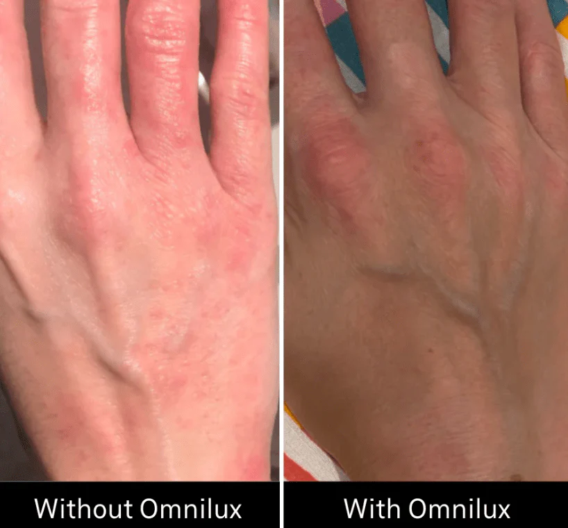 Omnilux Contour Glove - Image 9