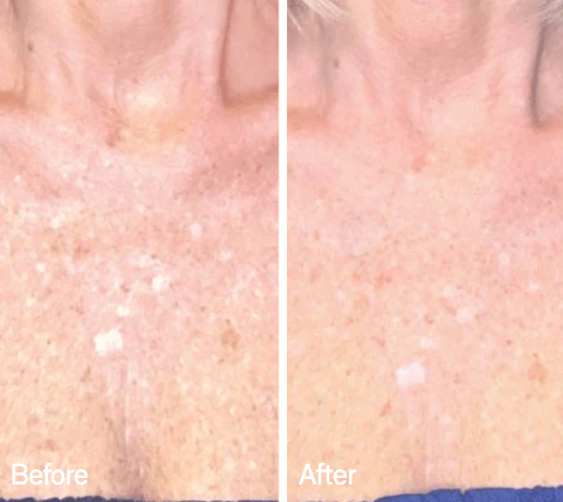 Omnilux Contour Neck & Décolleté - Image 10