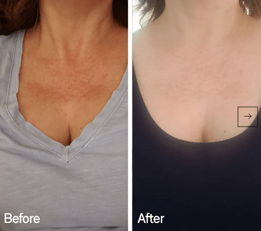 Omnilux Contour Neck & Décolleté - Image 5