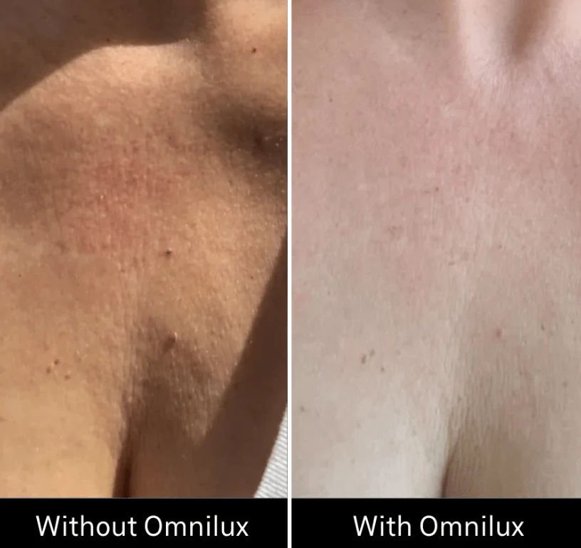 Omnilux Contour Neck & Décolleté - Image 9