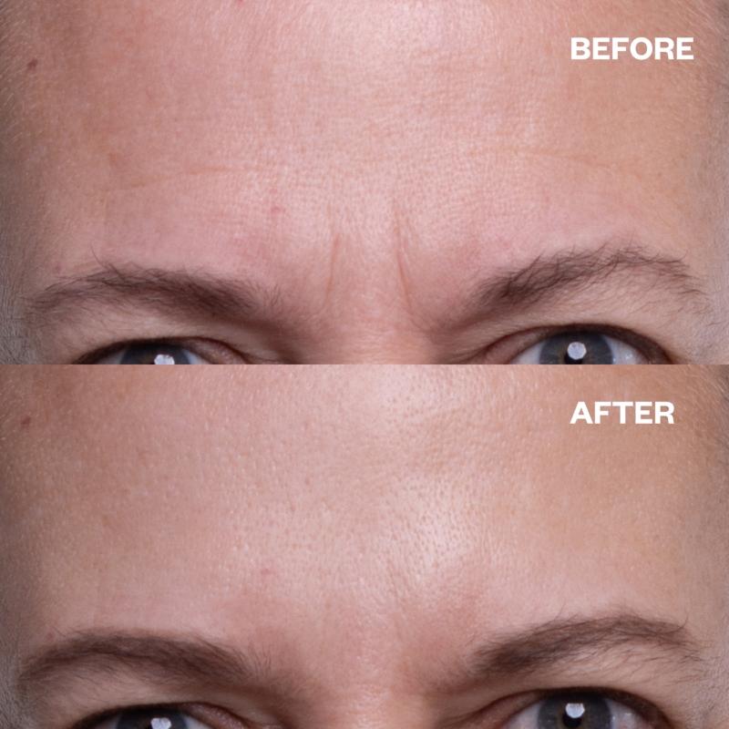 Wrinkles Schminkles Forehead Wrinkle Patch - 1 Patch - Image 4