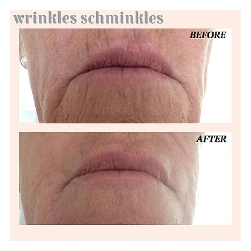 Wrinkles Schminkles Mouth and Lip Wrinkle Patch - 1 Patch - Image 2